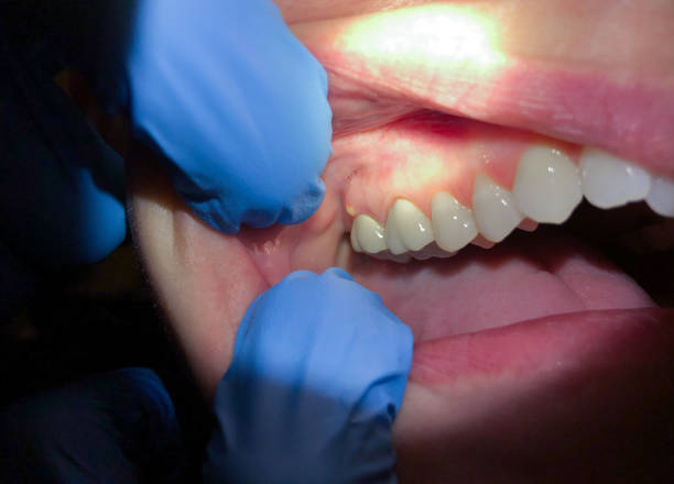 Best Emergency Wisdom Teeth Removal in Raoul, GA