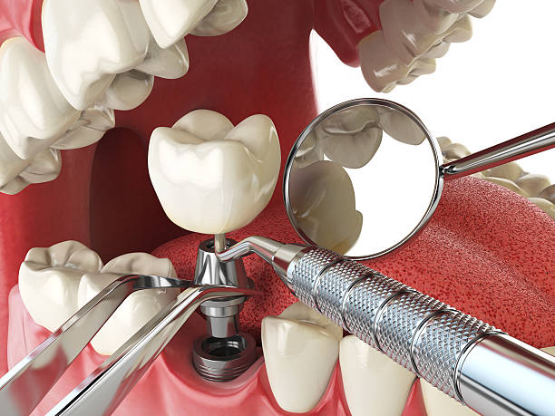 Best Emergency Root Canal Treatment in Raoul, GA